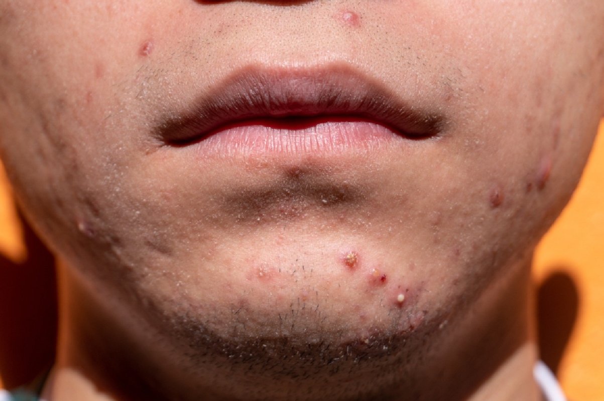 acide salicylique et acné - gel nettoyant pour acné